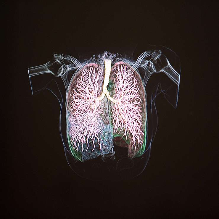 3D-Visualisierung der Lunge.